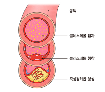 이상지질혈증