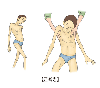 근육병