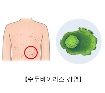 수두