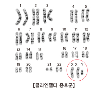 클라인펠터 증후군